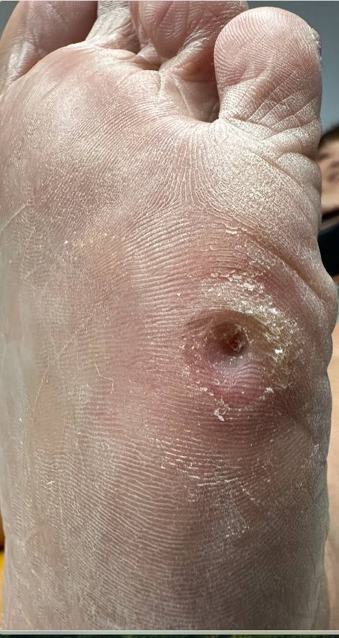 After core removal
