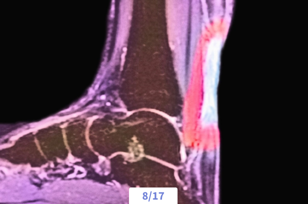 MRI scan showing a cross-section of a foot with highlighted red area indicating inflammation or injury.