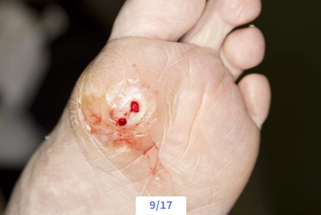 Close-up of a person's foot showing a new blister with a small bleeding wound.