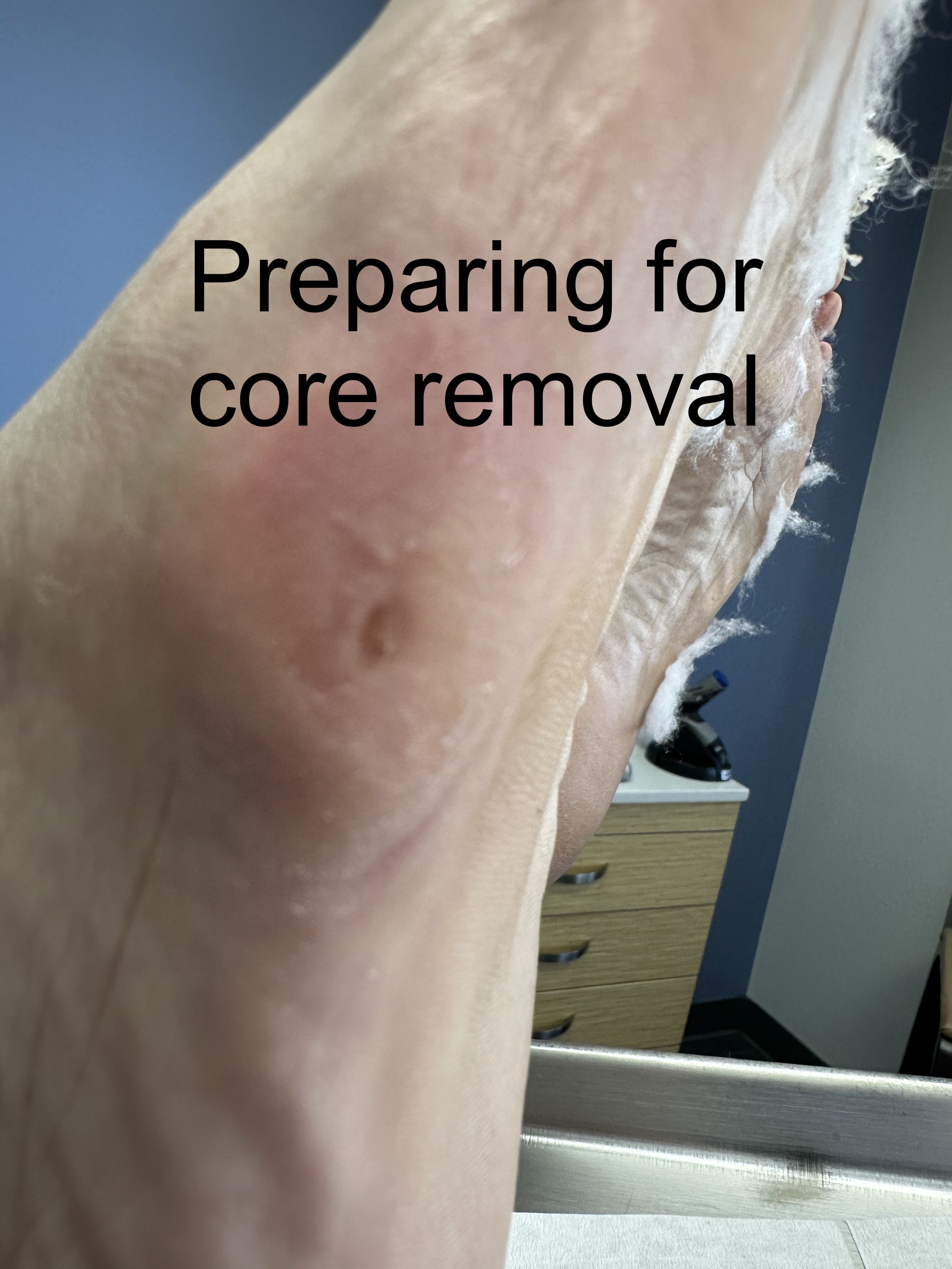A person's leg with a surgical scar, preparing for core removal surgery, with a wooden dresser and a blue wall in the background.