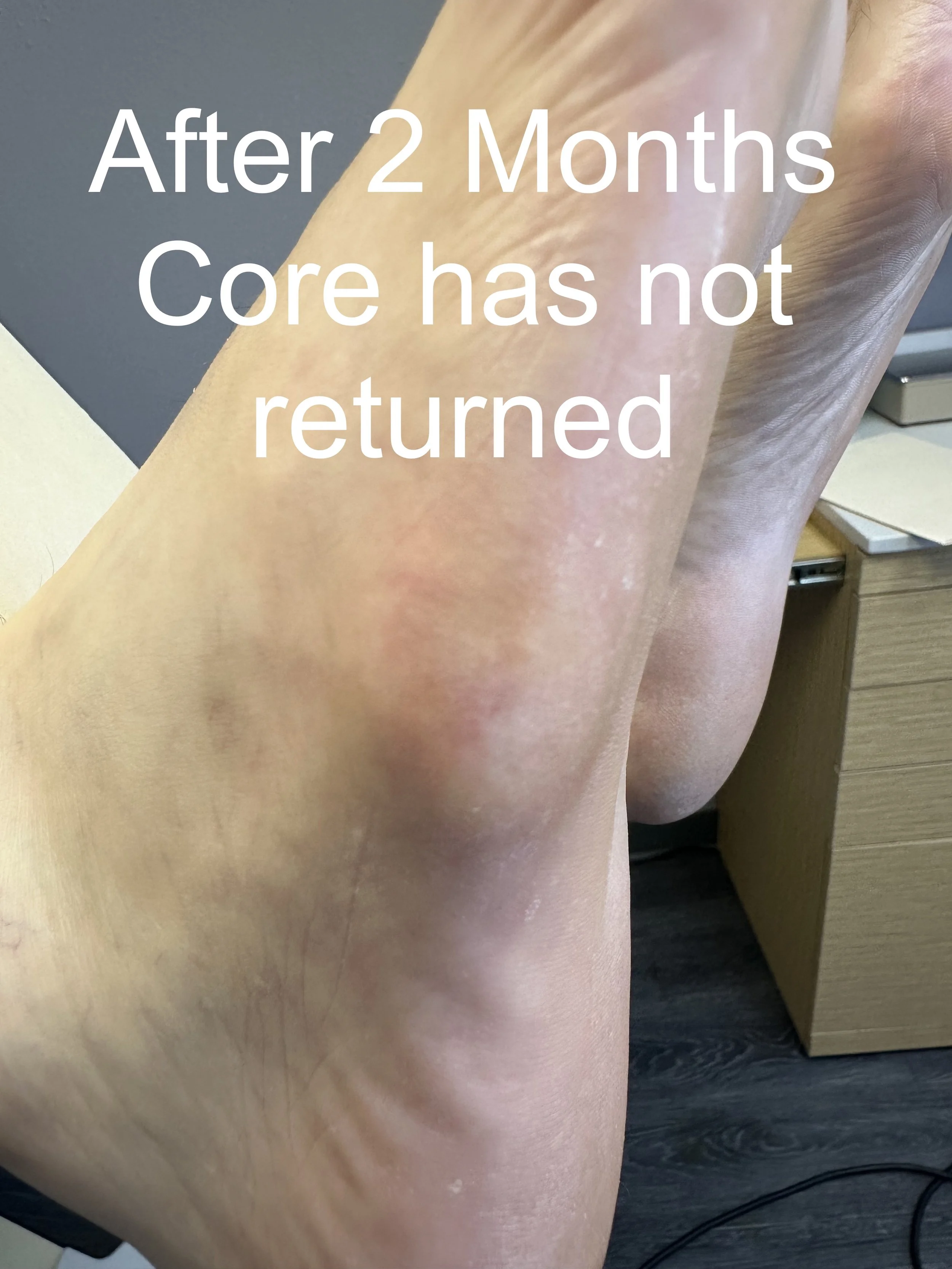 Close-up of a person's thigh with the text 'After 2 Months Core has not returned' overlaid on the image.