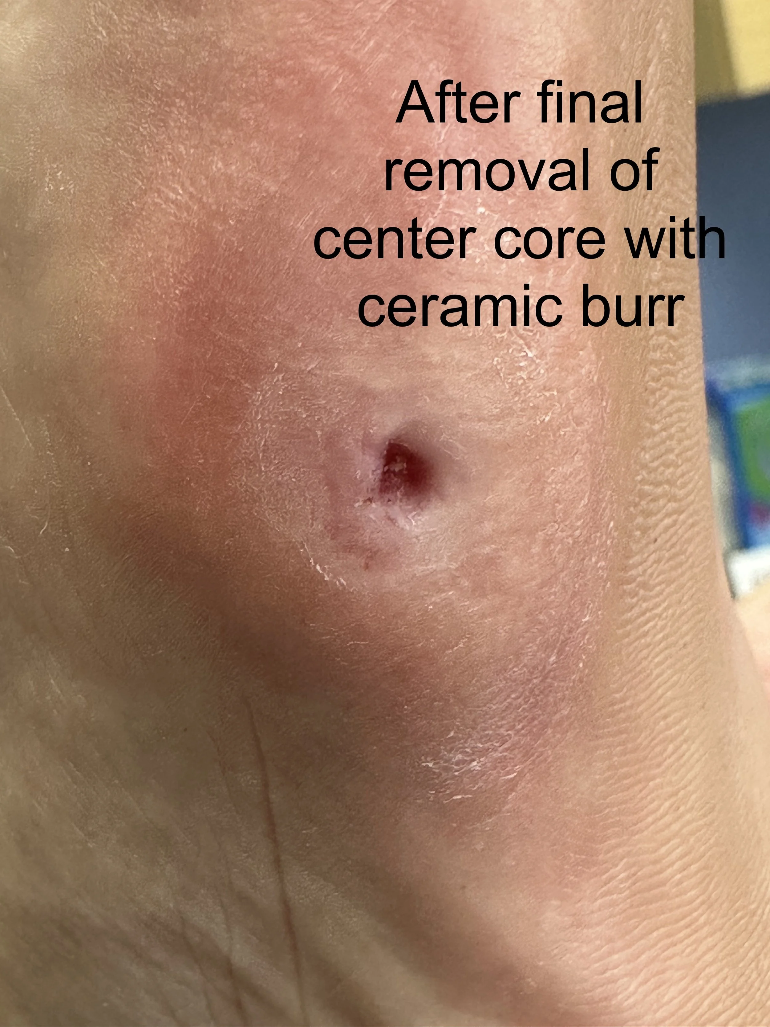 Close-up image of a person's skin, showing the area around the navel, with a caption stating it is after the final removal of a center core with ceramic burr.