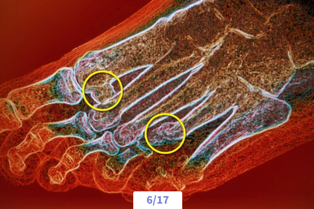 Colored scan of a human foot highlighting bones with yellow circles.