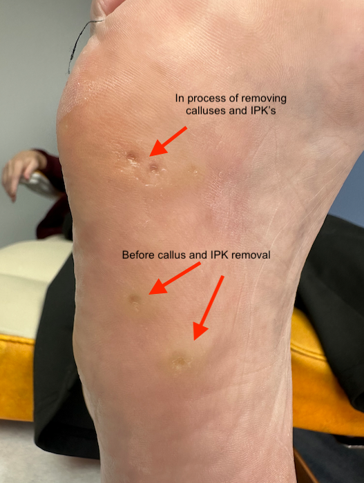valeri right foot callus removal  first visit march 2026.png