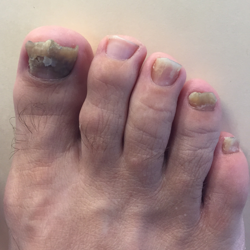 Close-up of a person's hand with severely damaged and discolored fingernails.