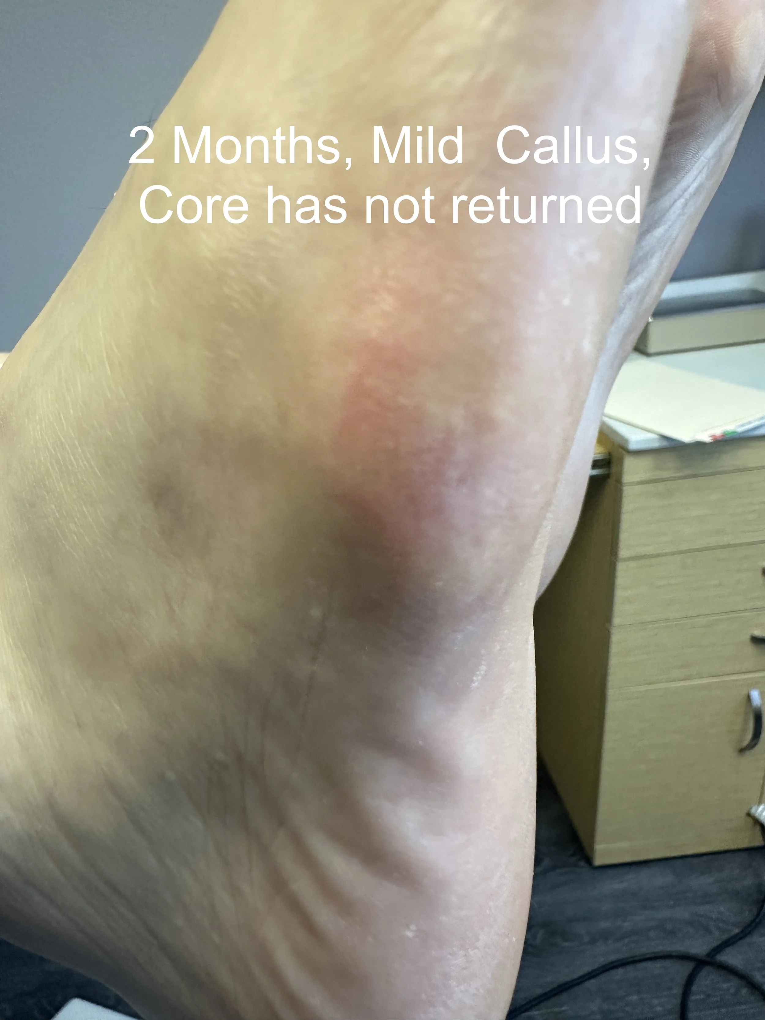 Close-up of a person's leg with visible red marks and a bandage near the knee, resting on a wooden desk with a yellow notepad and a black device in the background.