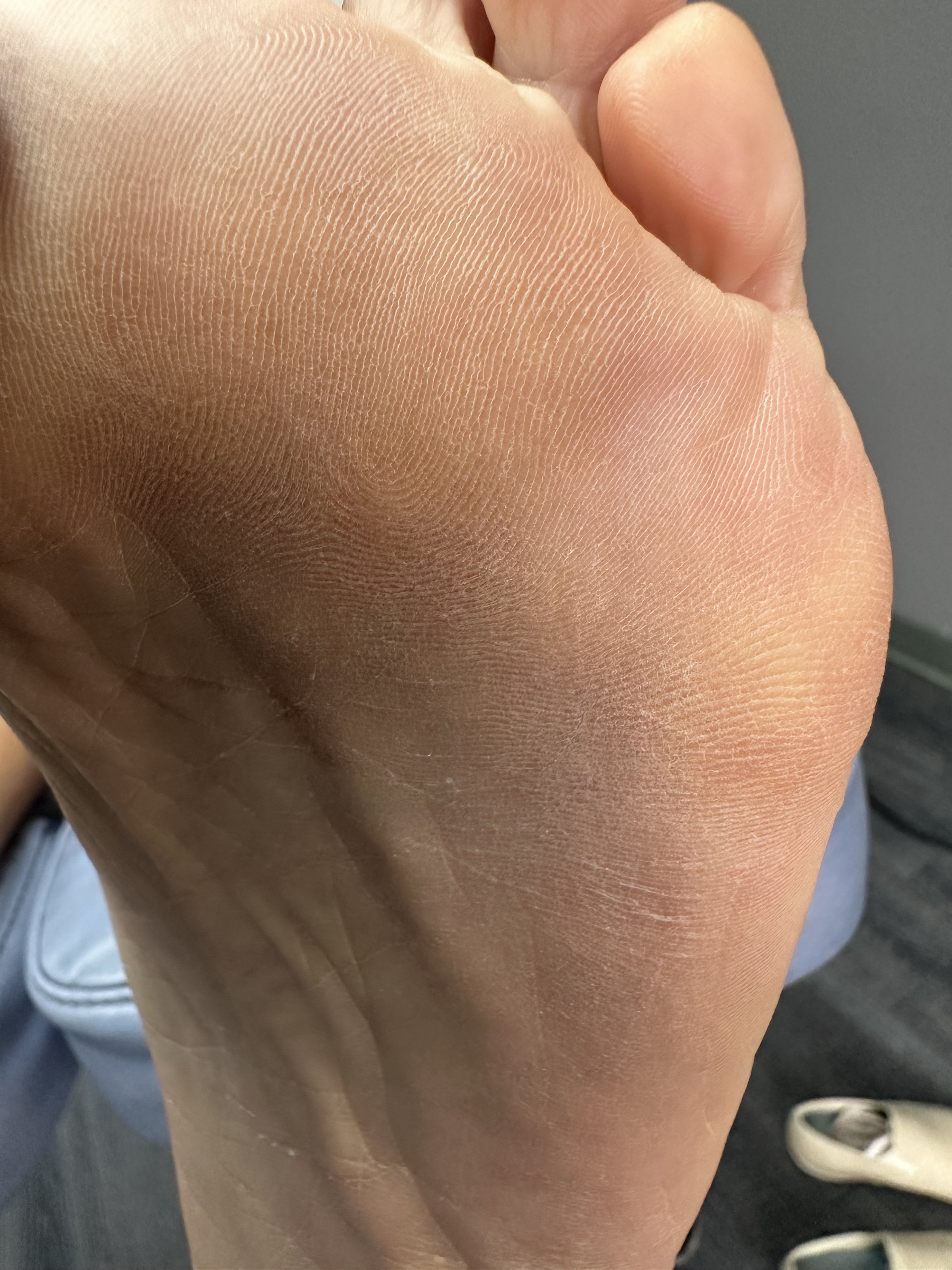 Appearance of the same plantar area at follow-up on October 21, 2026