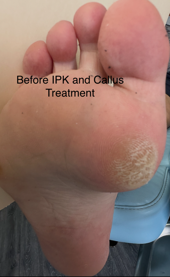 Patient Before & After IPK