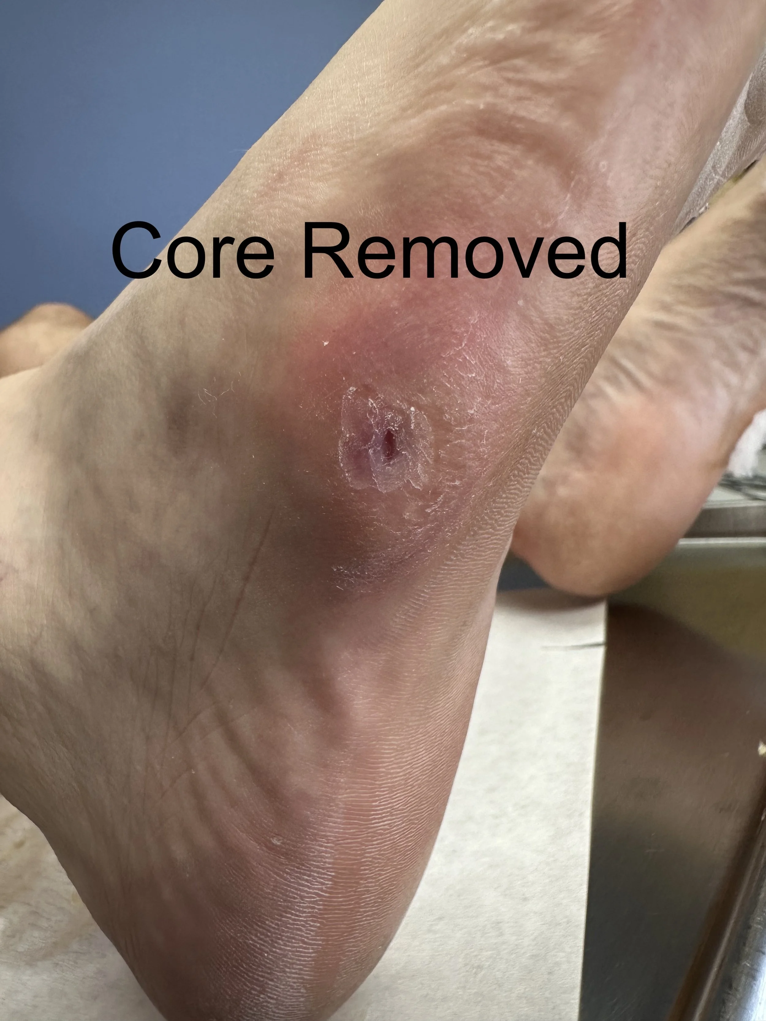 Close-up of a person's foot with a visible sore and skin irritation, with the overlay text 'Core Removed'.