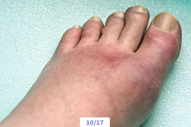 Close-up of a swollen, discolored toe with redness and inflammation.