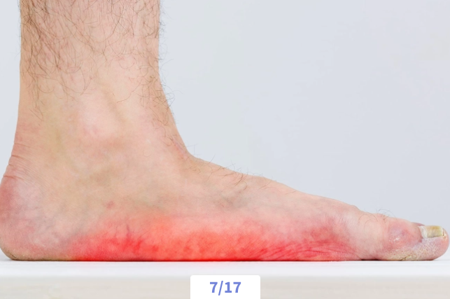 Close-up of a person's foot with redness and skin irritation on the sole and heel.