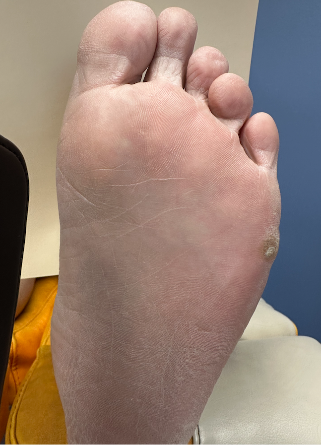 Initial photo pre treatment