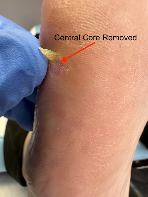 valeri central core removed .png