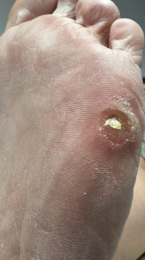 During callus removal