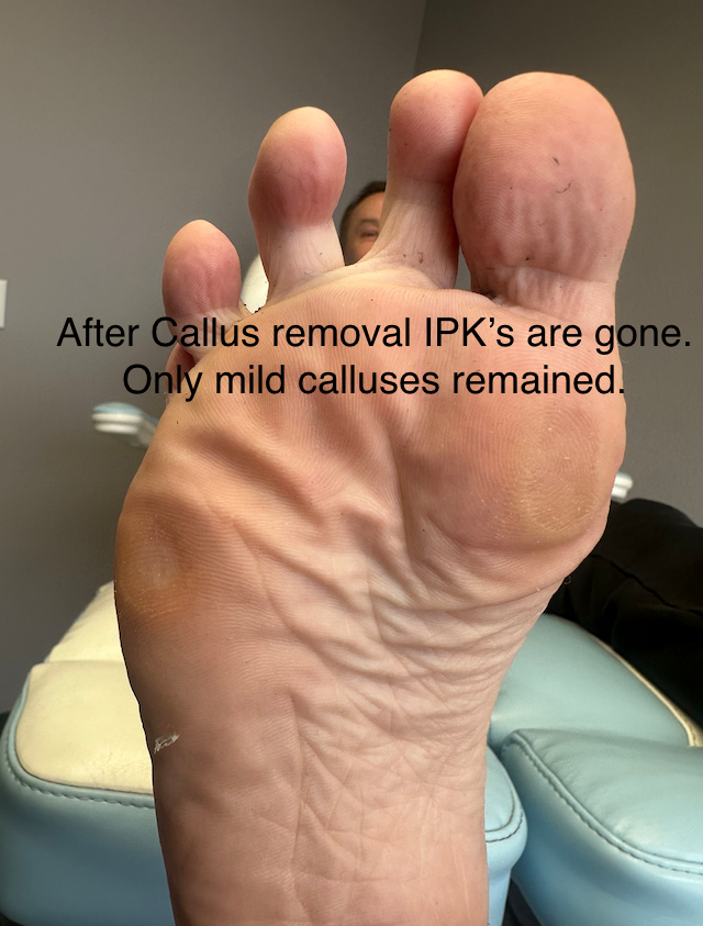 Before and After IPK Treatment