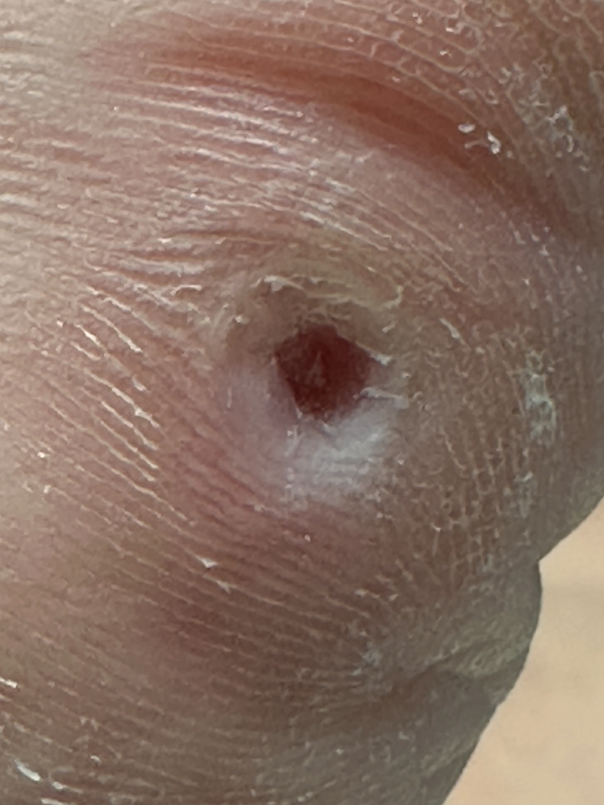 After final removal of center core with ceramic burr