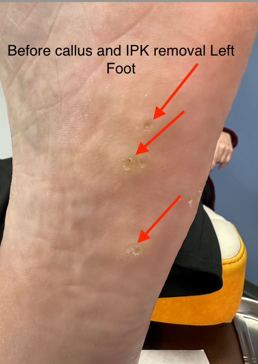 valeri befroe callus and ipk removal left foot march 2026.png