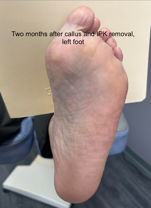 valeri, 2 months after callus and ipk removal.png