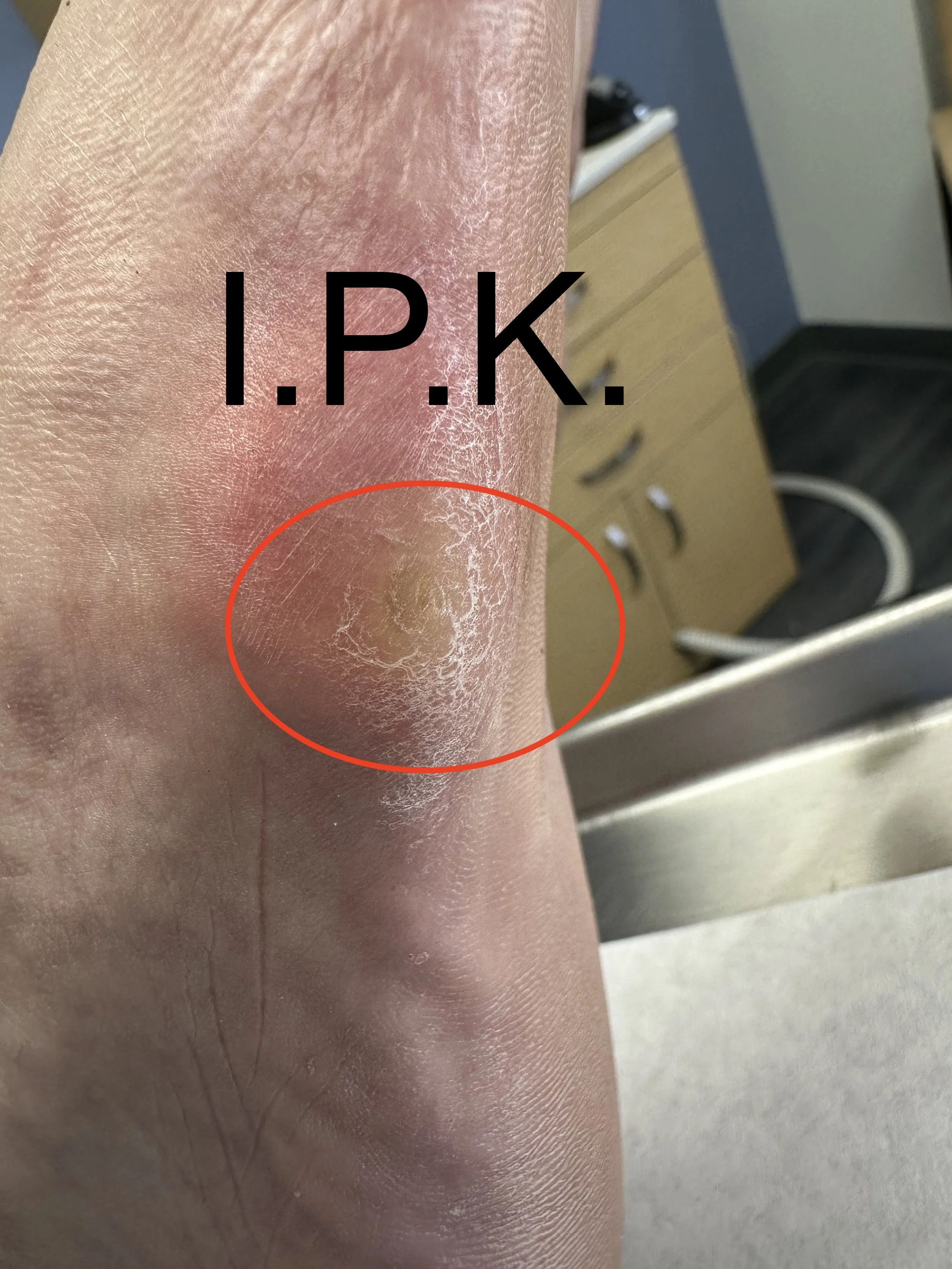 Close-up of a person's dry, cracked skin on their foot, with a red circle highlighting an area of concern and the text 'I.P.K.' over the image.