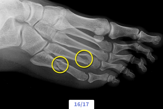 X-ray of a human foot showing two fractures in the second and third toe bones, highlighted with yellow circles.