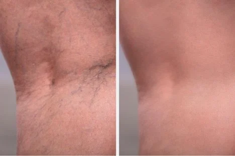 Sclerotherapy treated leg before and after - Pampered Soul MedSpa Poncha Springs Salida Colorado