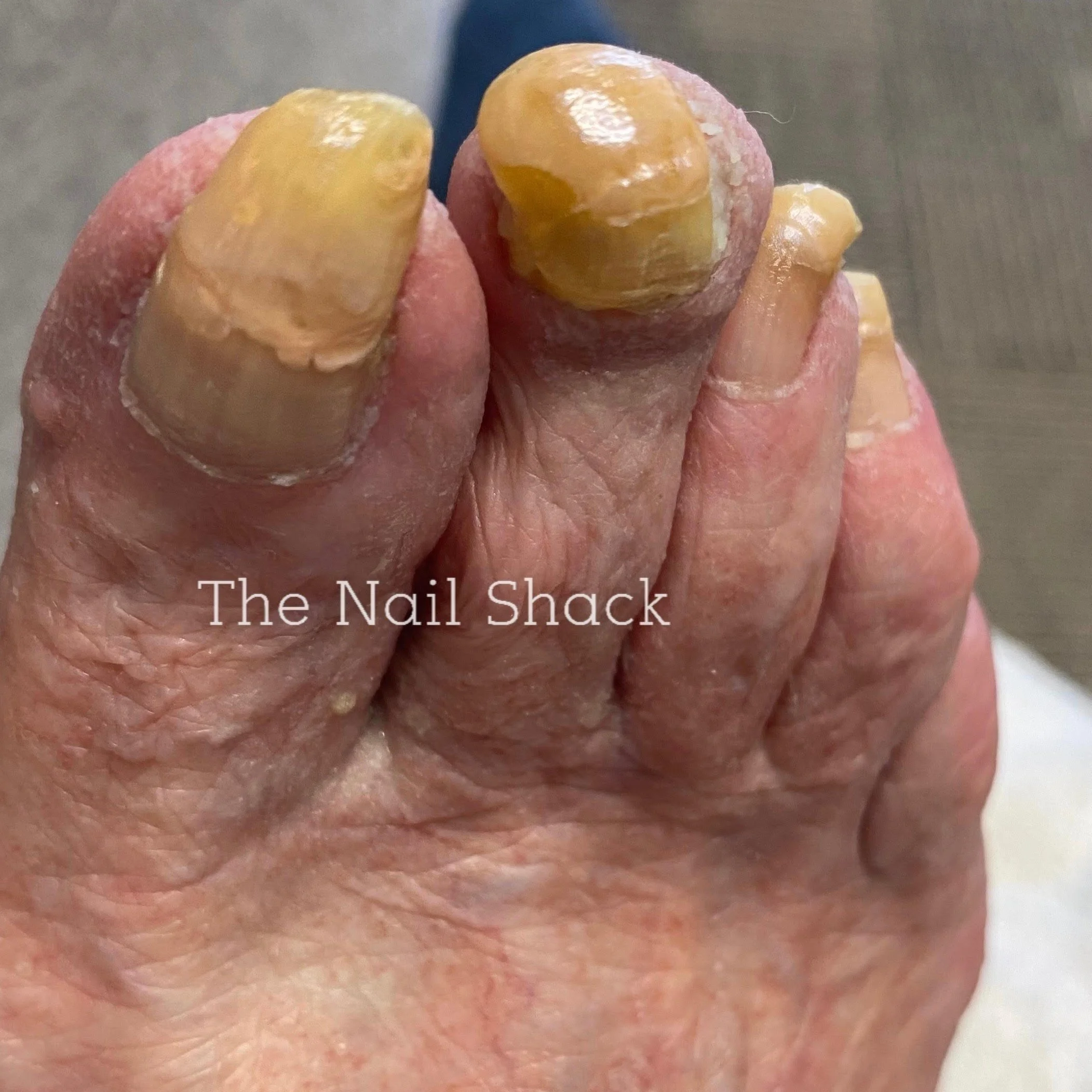 The Fear of Ingrown, THick Fungal Nails and what to do