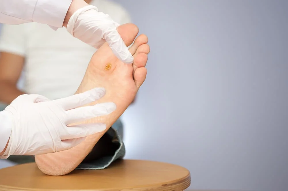 Treatment for Warts, Corns, Calluses, Foot Fungus Podiatrist West Haven, CT — West Haven Foot