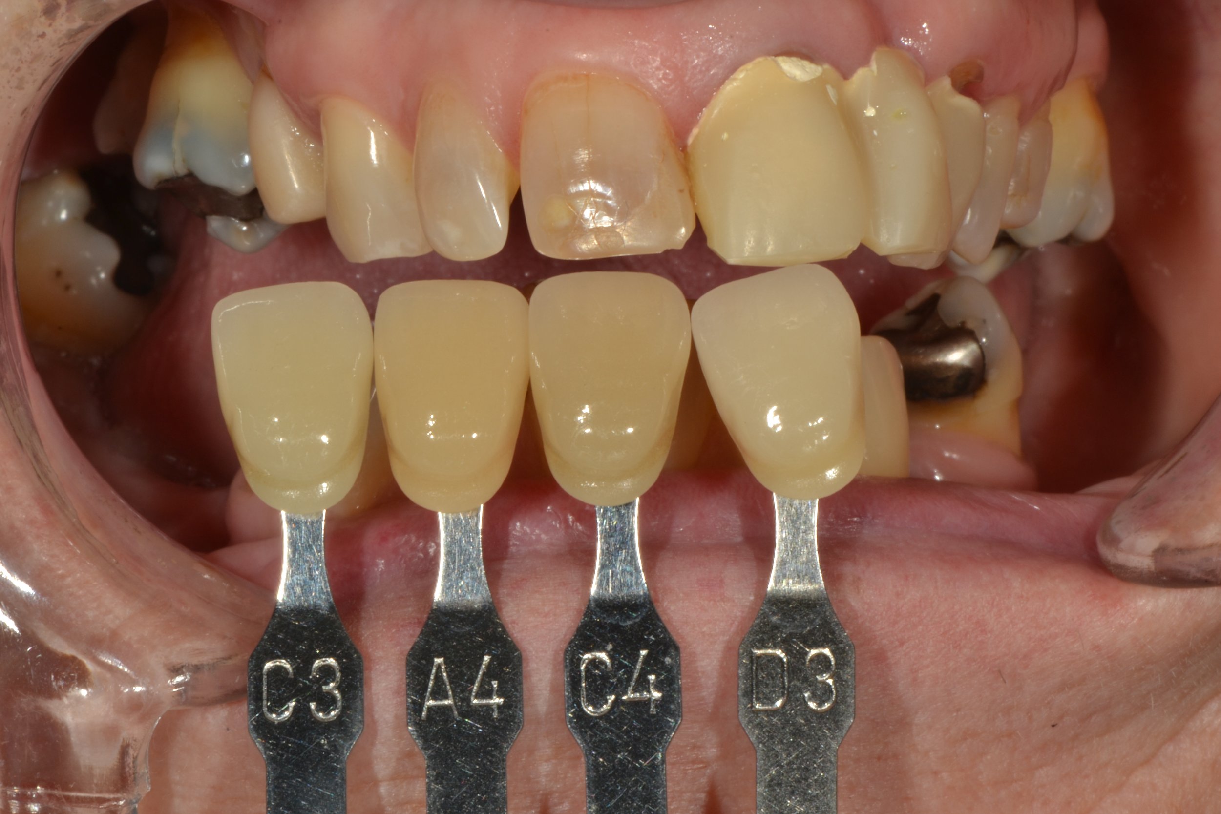  2.1 - 2.3 Layered Zr Anteriors 