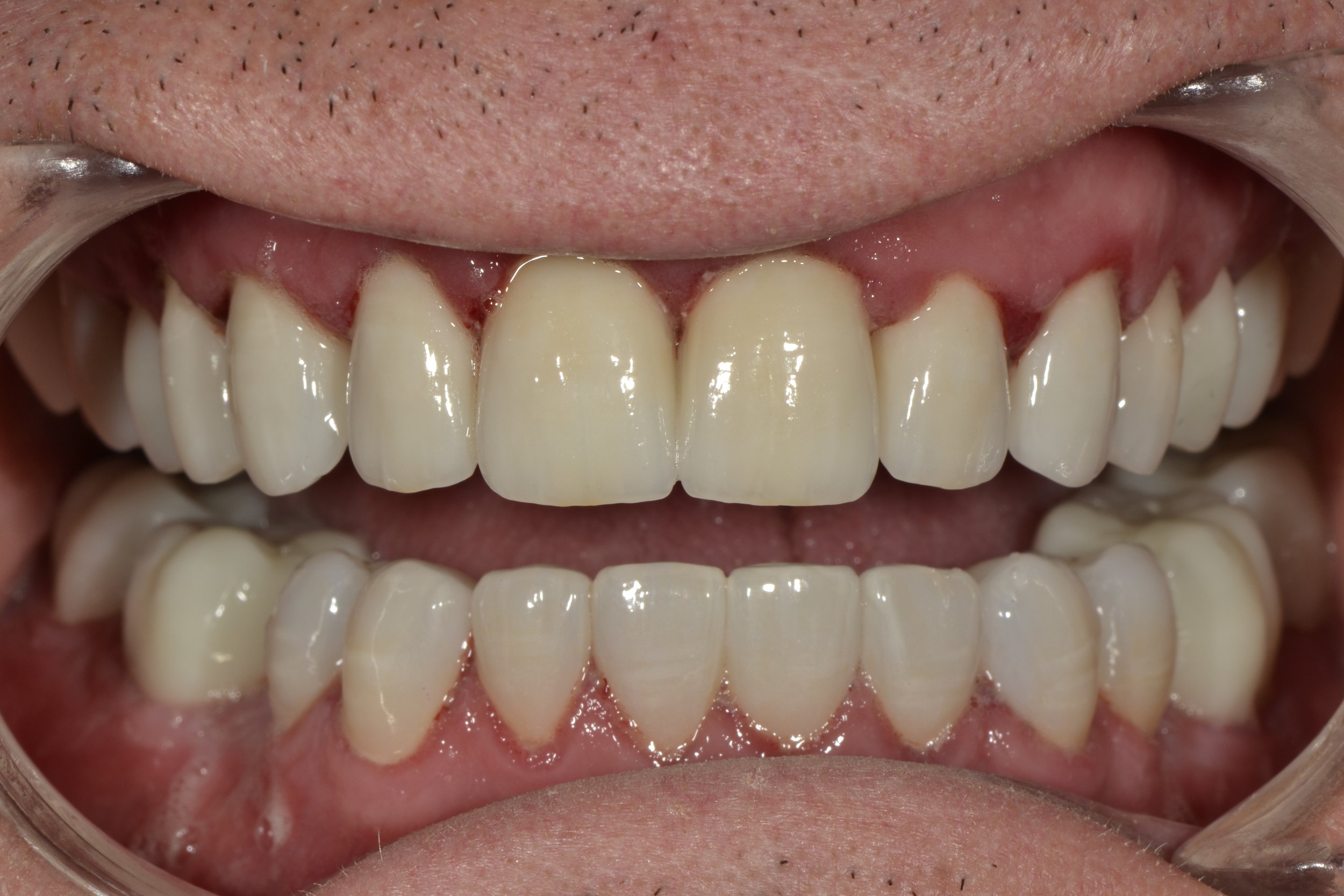  Full Mouth Recon. Layered Zr Anteriors + Monolithic Zr Posteriors 