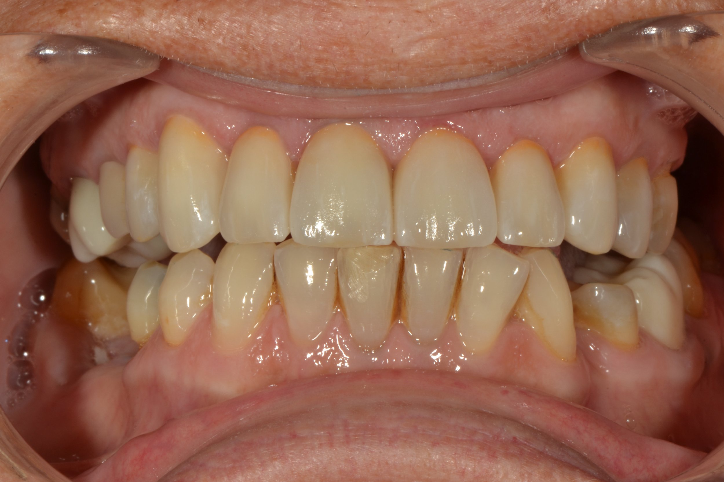  1.4 - 2.4 Layered Zr Anteriors + Hybrid Zr Posteriors 