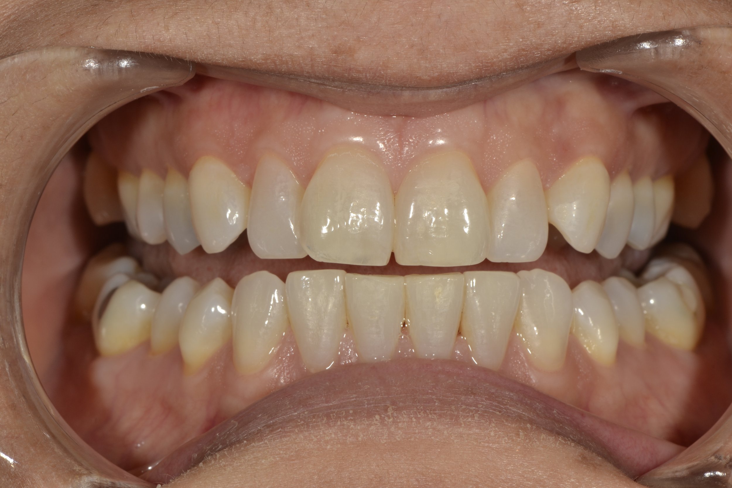  1.3 - 2.3 Monolithic Emax Veneers 