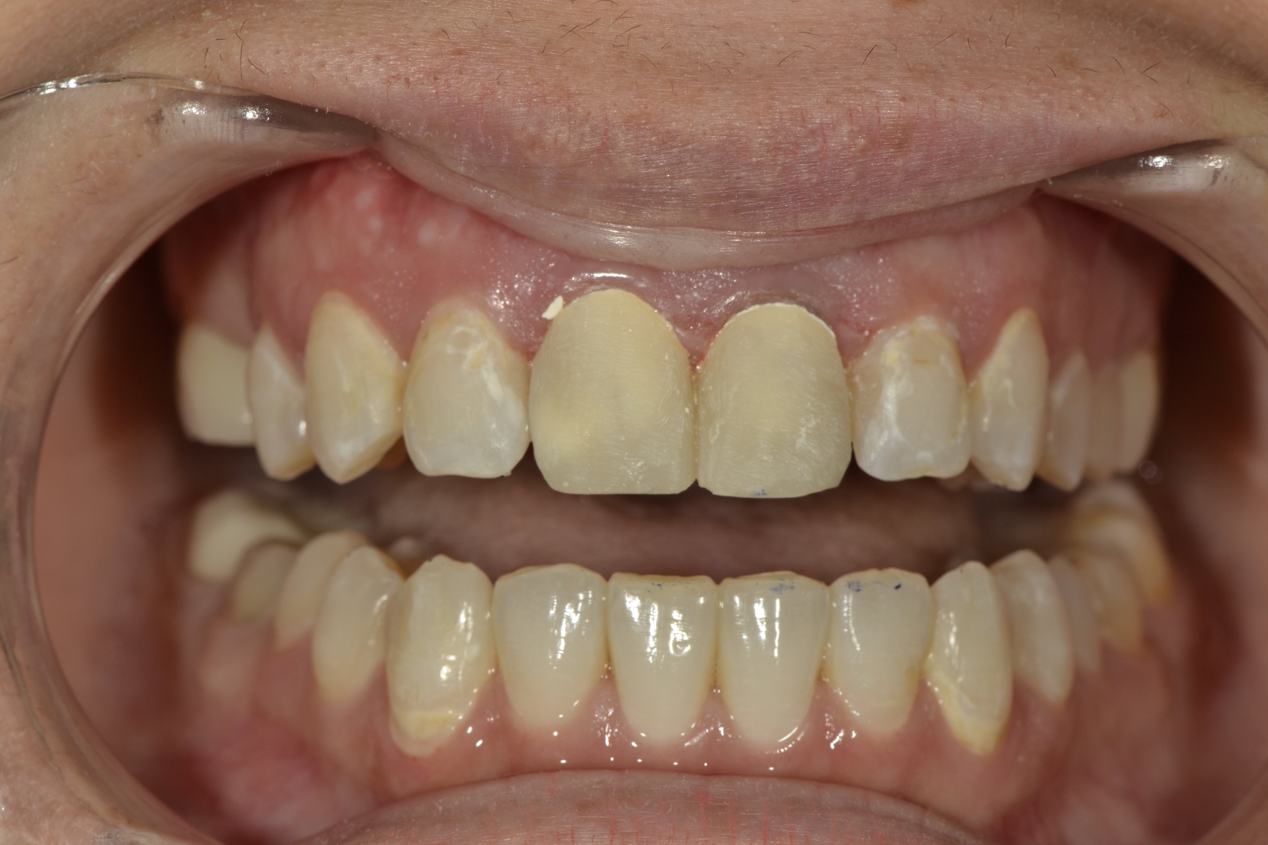  1.1 -2.1 Layered Zr Anteriors 