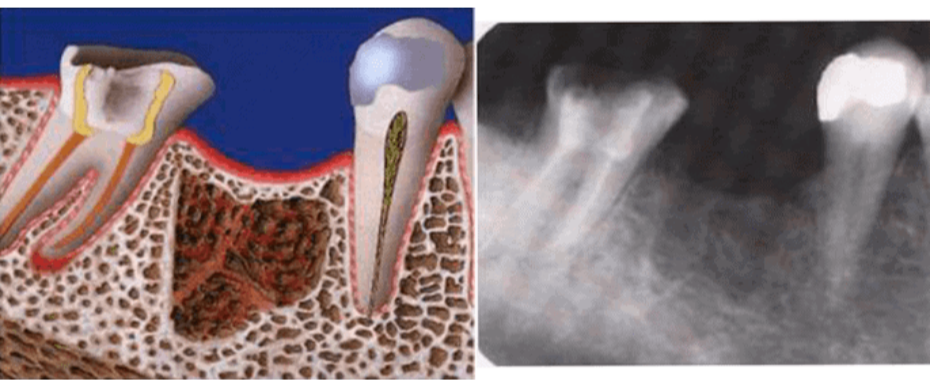What Are Cavitations—And Why They Matter in Dental Health