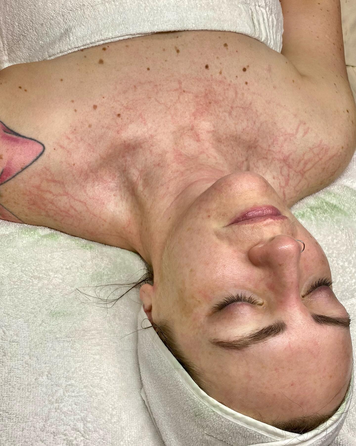 Love a good Plasmatic Effect 🤩

The Plasmatic Effect is a visible sign, indicating dilation of peripheral capillaries, lymph drainage and a rush of fresh oxygenated blood from within the skin into the capillaries- improving the overall health of the