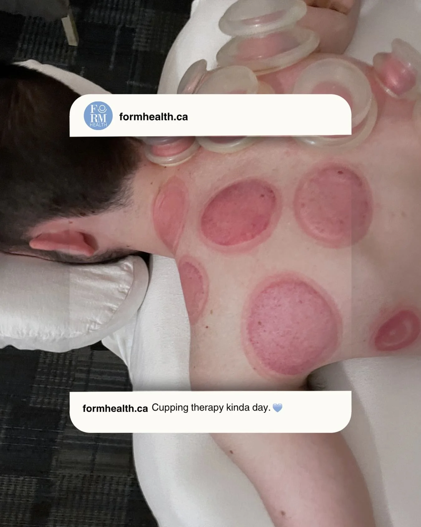 Curious about cupping?
This technique can help relieve muscle tension, improve circulation, and support recovery ✨

Talk with your massage therapist about incorporating cupping into your treatment, or book acupressure and cupping with Dr. Lorena!

#y