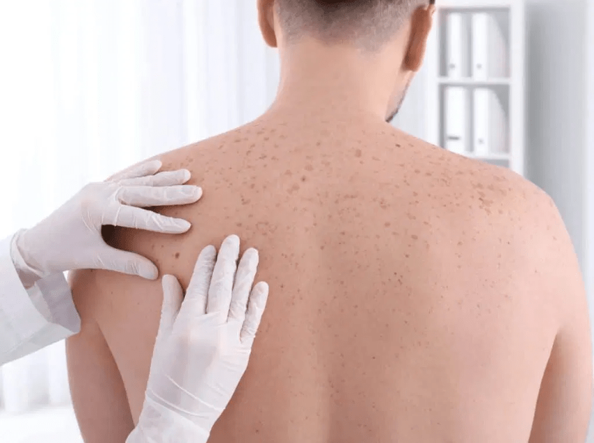 Skin Check in Newcastle: Your Guide to Early Detection and Prevention of Skin Cancer