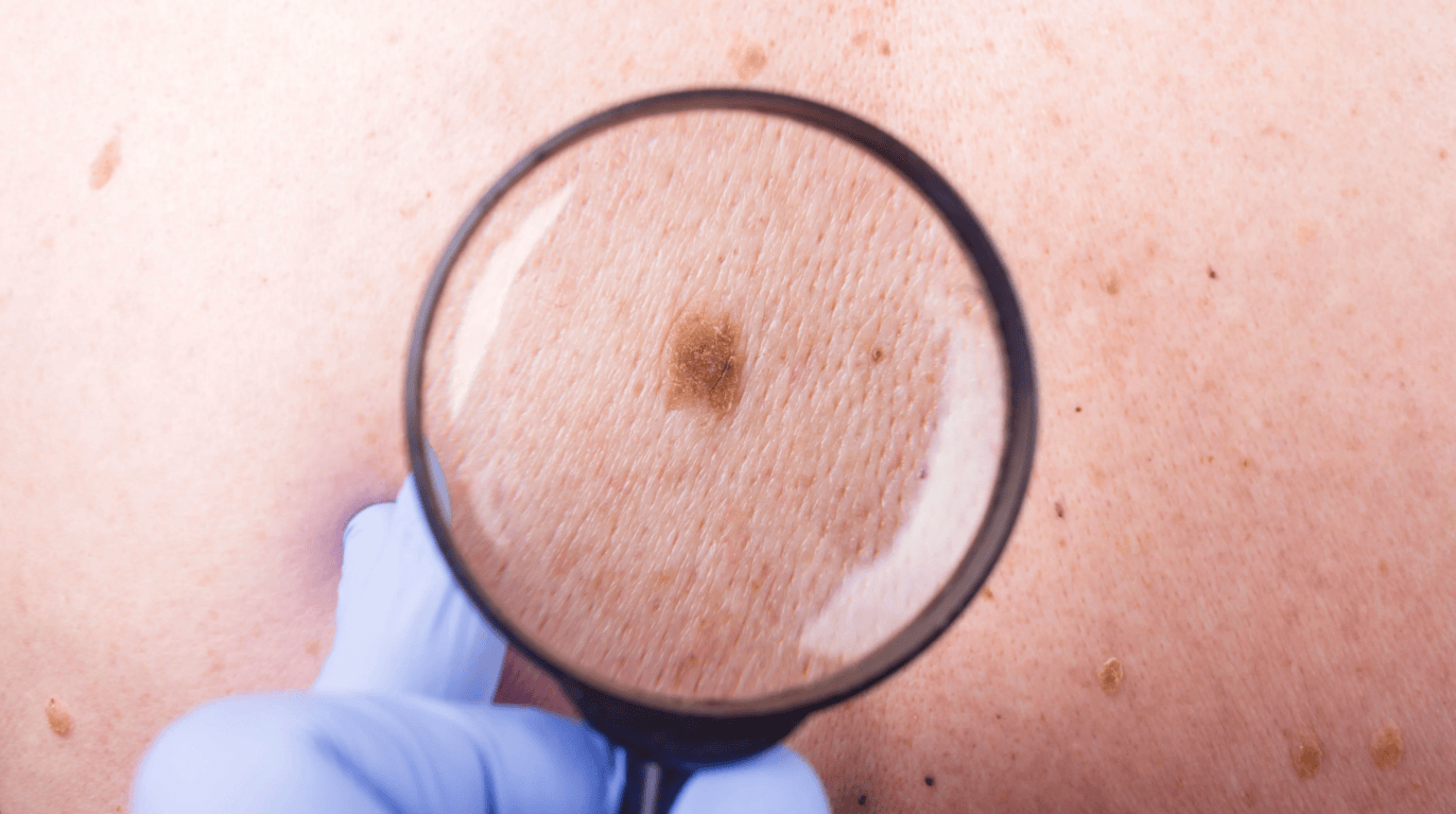 Skin Check in Newcastle: Why Regular Skin Checks are Essential for Your Health