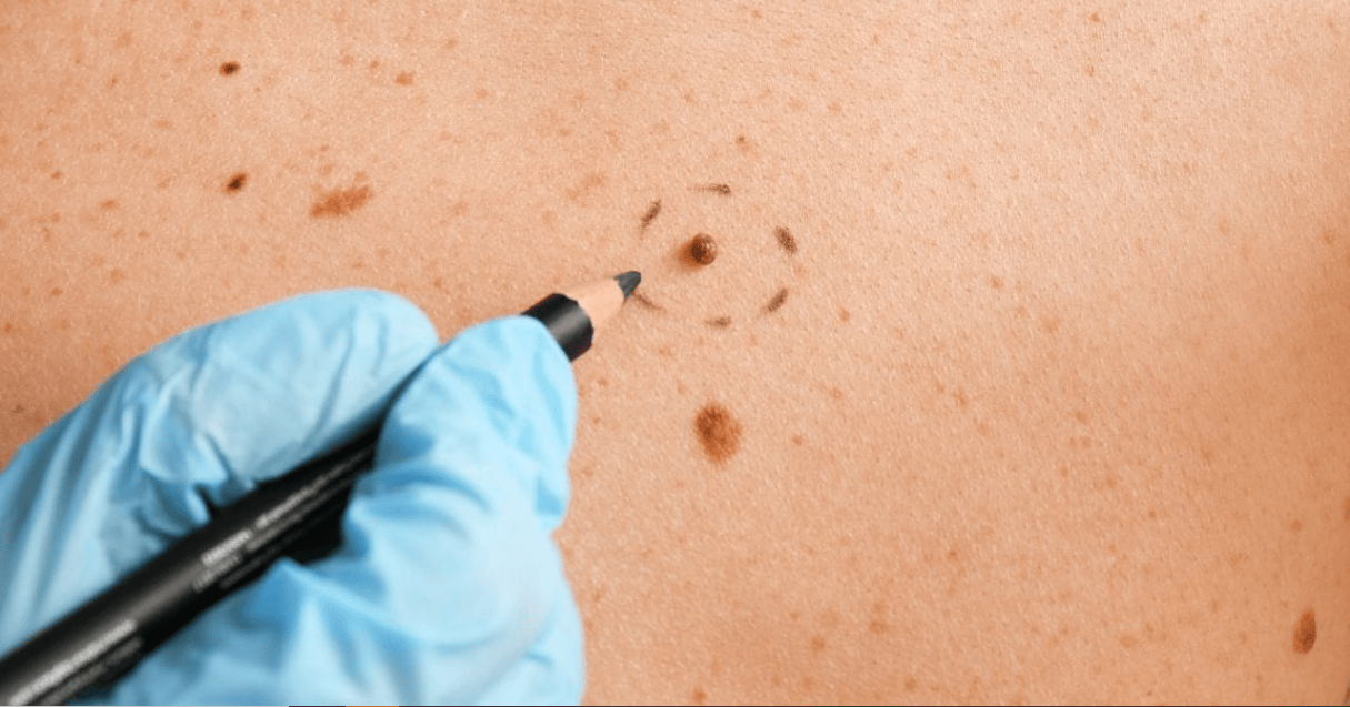 Mole Removal in Newcastle: Why It’s Important for Your Skin Health