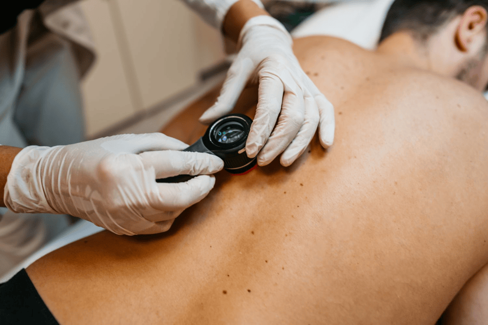 Skin Cancer Checks in Newcastle: Why Regular Screenings Are Essential