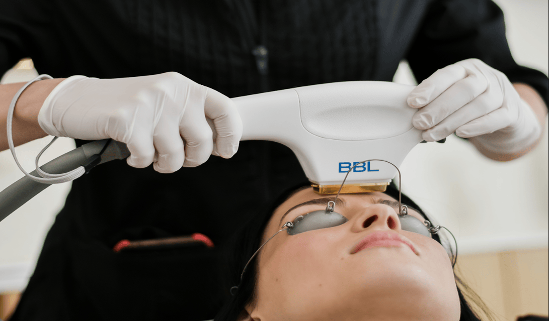 Achieve Radiant, Youthful Skin with BBL Laser at Newcastle Skin Clinic