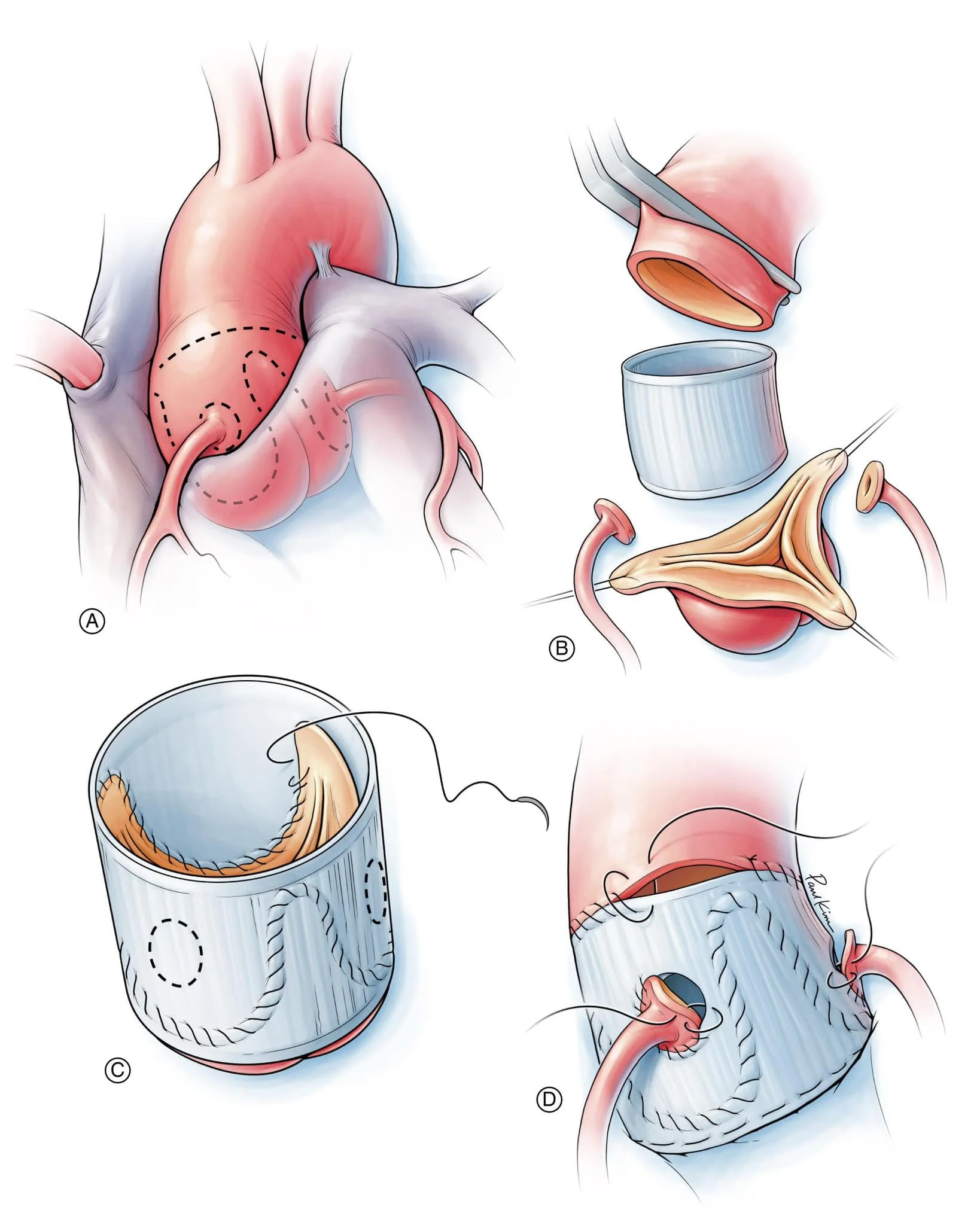 Heart Surgery Milestone at Songdo Hospital