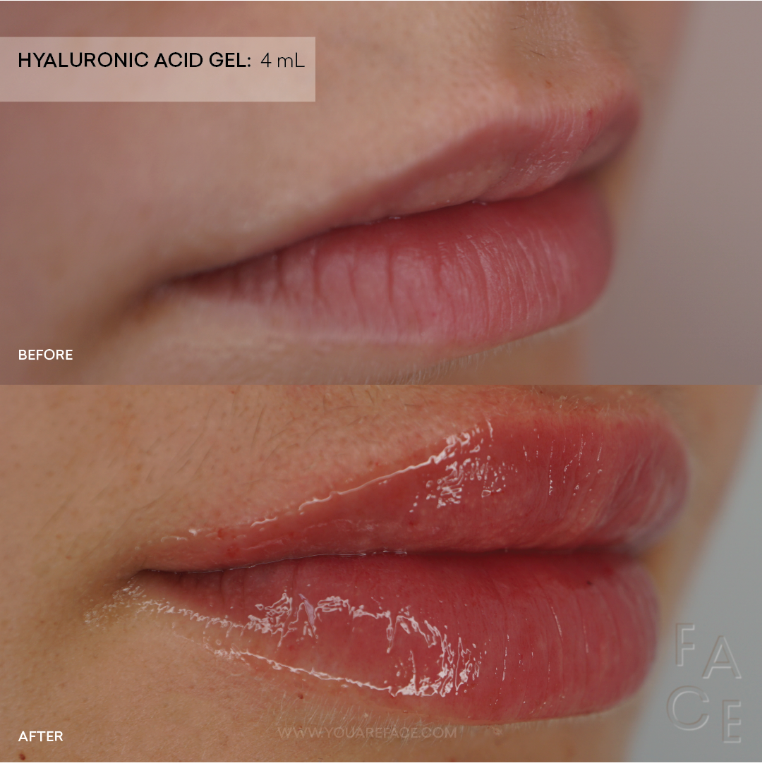 Hyaluronic Acid Gel with Hyaluron Pen Oakland & LA — FACE