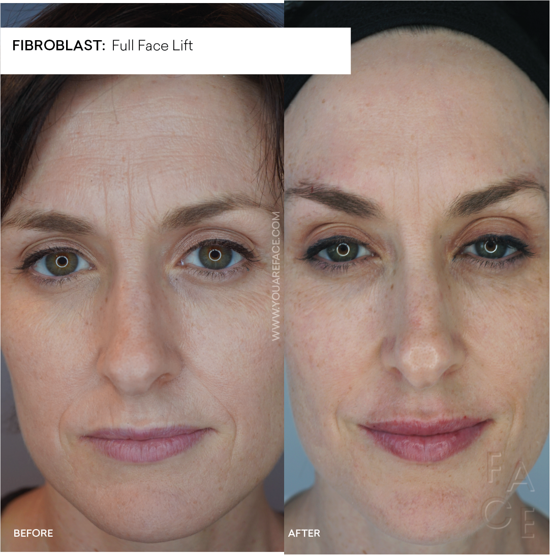 Plasma Fibroblast Skin Tightening With Plasma Pen Oakland And La — Face