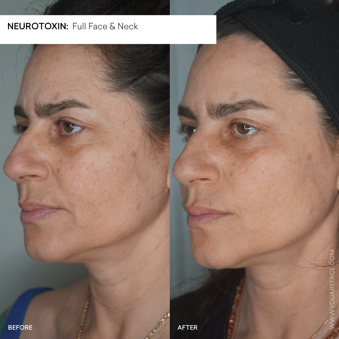 neurotoxin-full-face-neck-before-after-wrinkles-lift.png