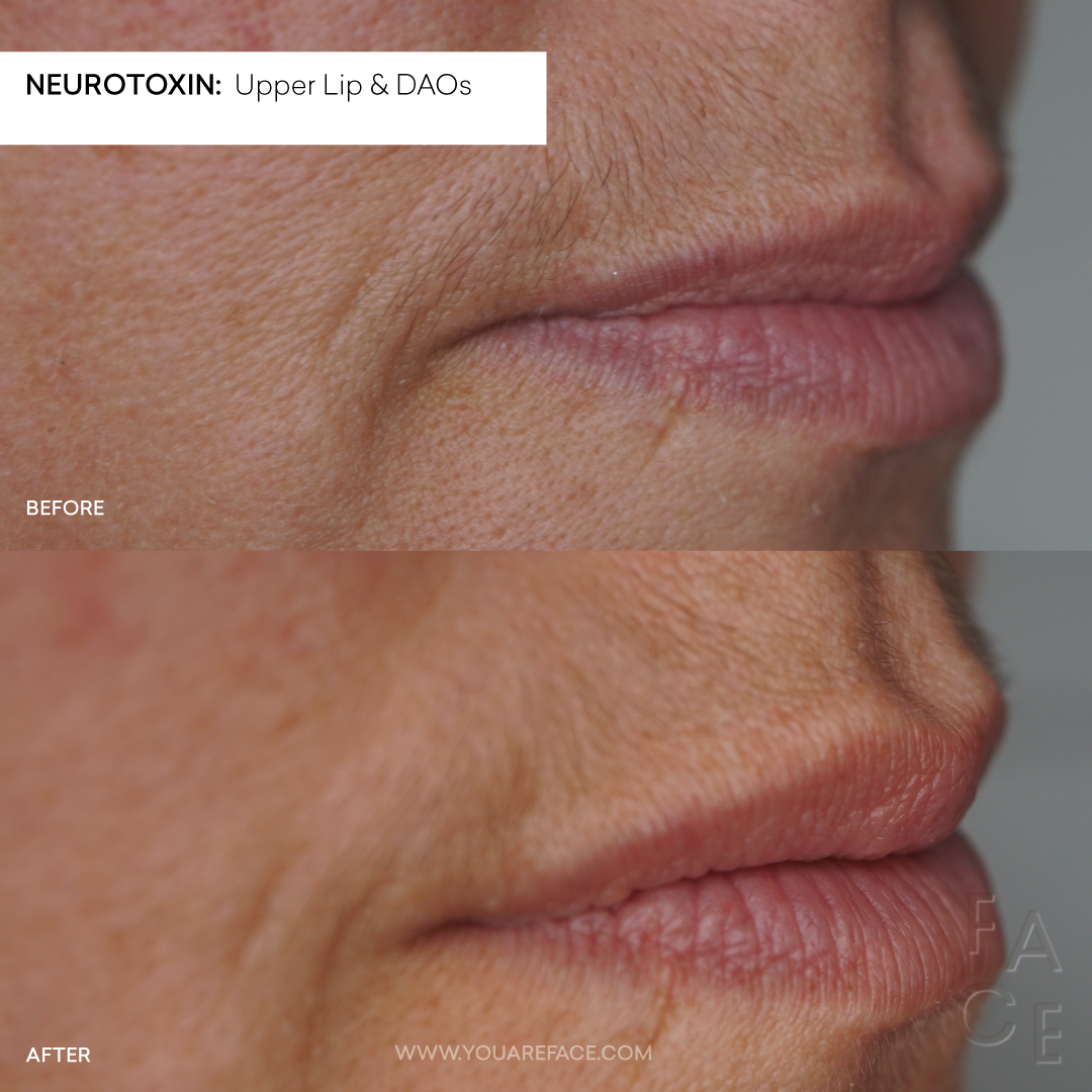 lip-flip-daos-before-after-side-view-mouth-corner-lift-neurotoxin.png
