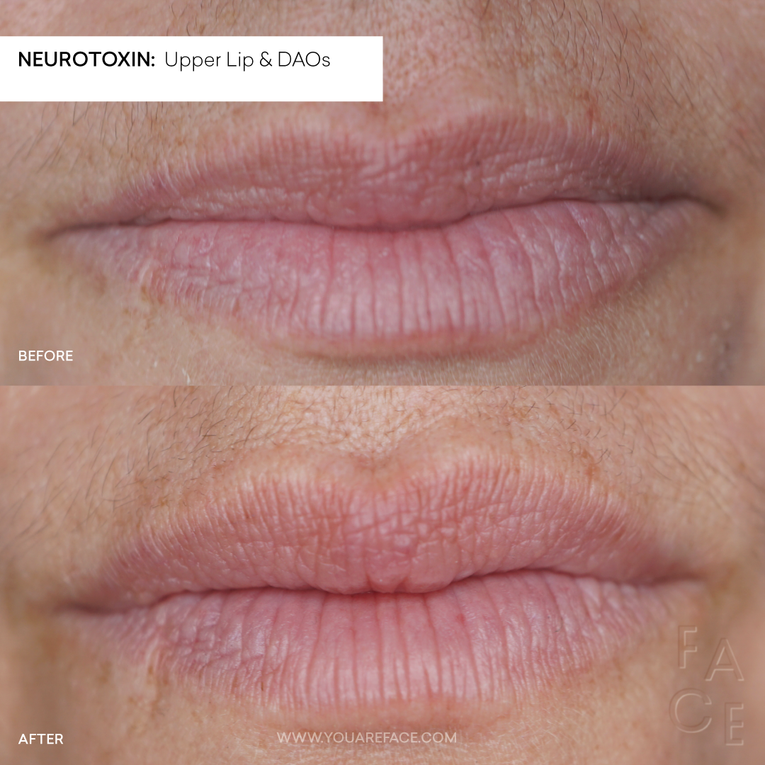 neurotoxin-upper-lip-daos-before-after-lip-flip-mouth-corners.png