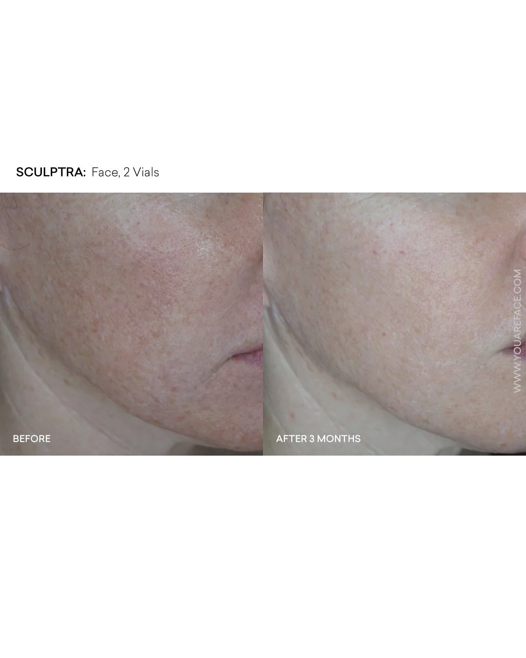 ✨ Subtle and Natural Transformation with Sculptra&reg; ✨
Check out these beautiful results 3 months after just two vials of Sculptra&reg;! This collagen-stimulating treatment restores volume naturally, improving skin firmness, texture, and overall yo