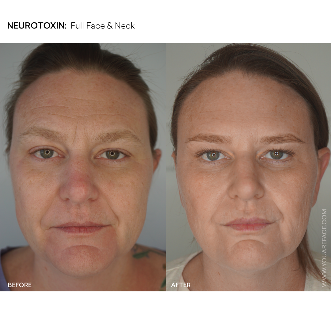 neurotoxin-before-after-full-face-neck-oakland-med-spa.png