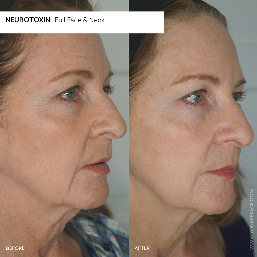 full-face-neck-neurotoxin-before-after-oakland.png