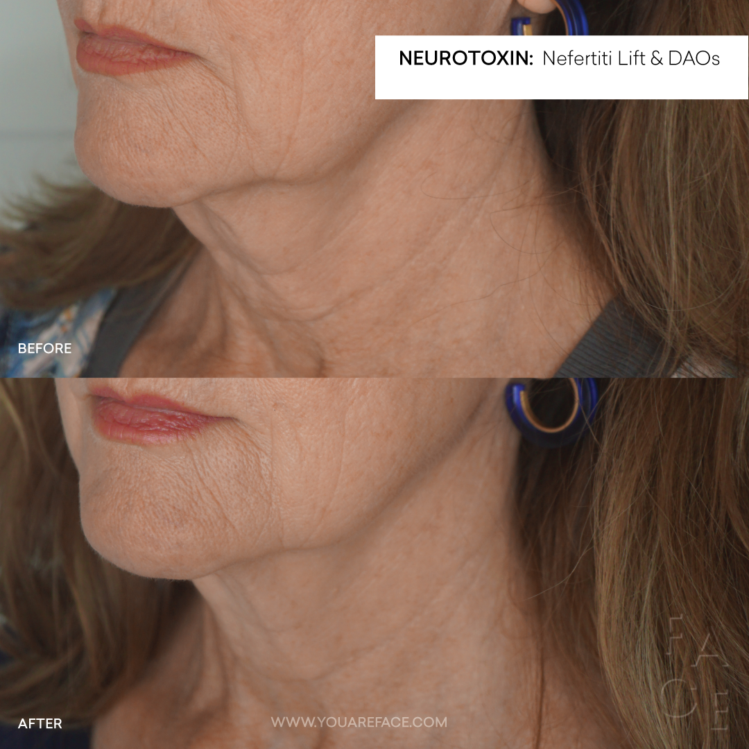 nefertiti-lift-dao-neurotoxin-before-after-neck-jawline-oakland.png